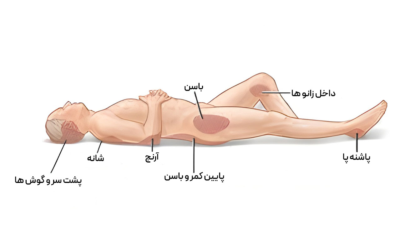 زخم بستر در کدام نقاط بدن شکل میگیرد ؟